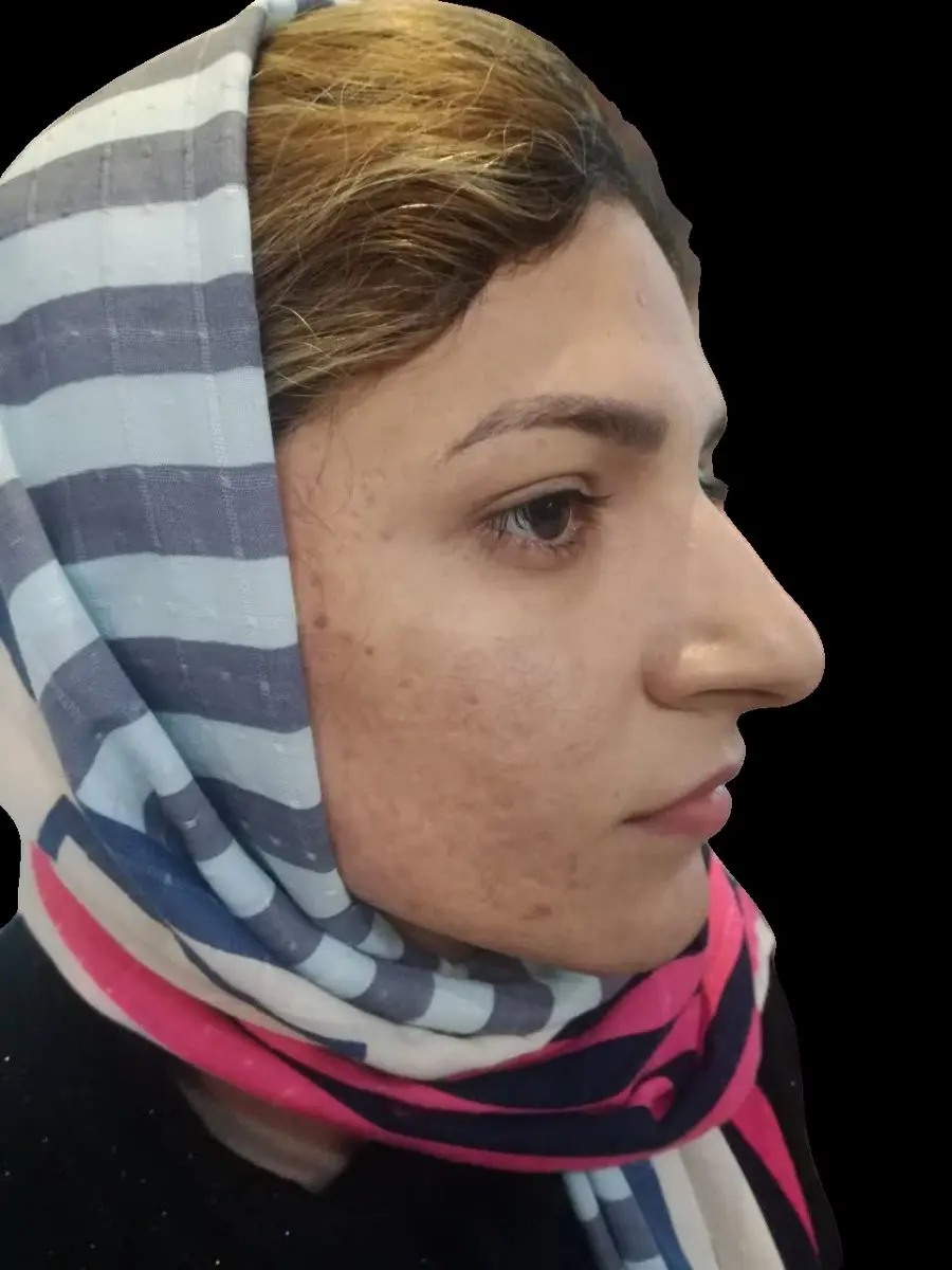 Acne and acne scarring eight weeks after one Plexr Plus treatment