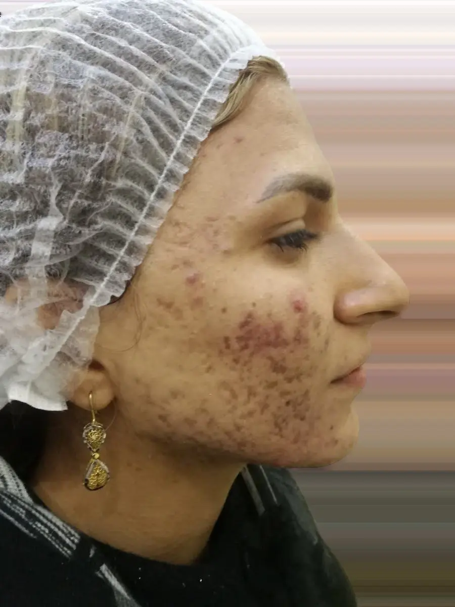 Acne and acne scarring before Plexr Plus treatment