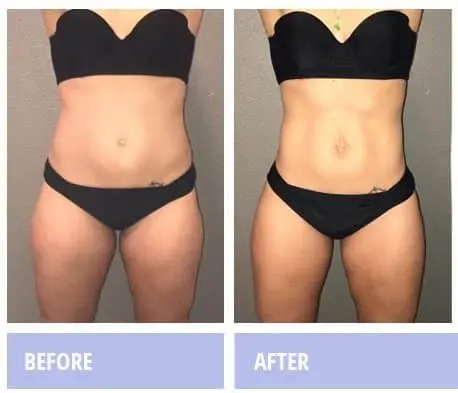 Woman, front view, before and after a Zerona course