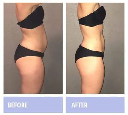 Woman, side view, before and after a Zerona course