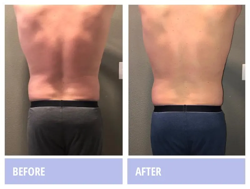Man, back view, before and after a Zerona course