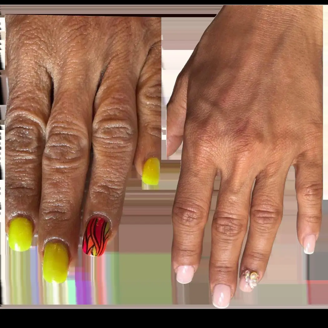Backs of the hands before and after Plexr Plus rejuvenation