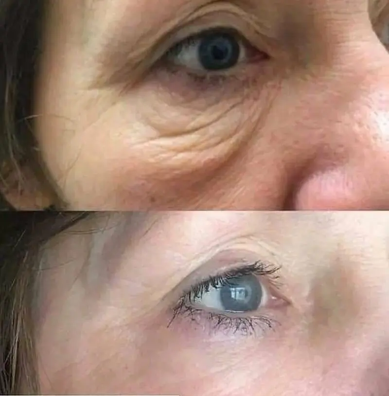 Lower eyelid and under-eye before and after Plexr Plus