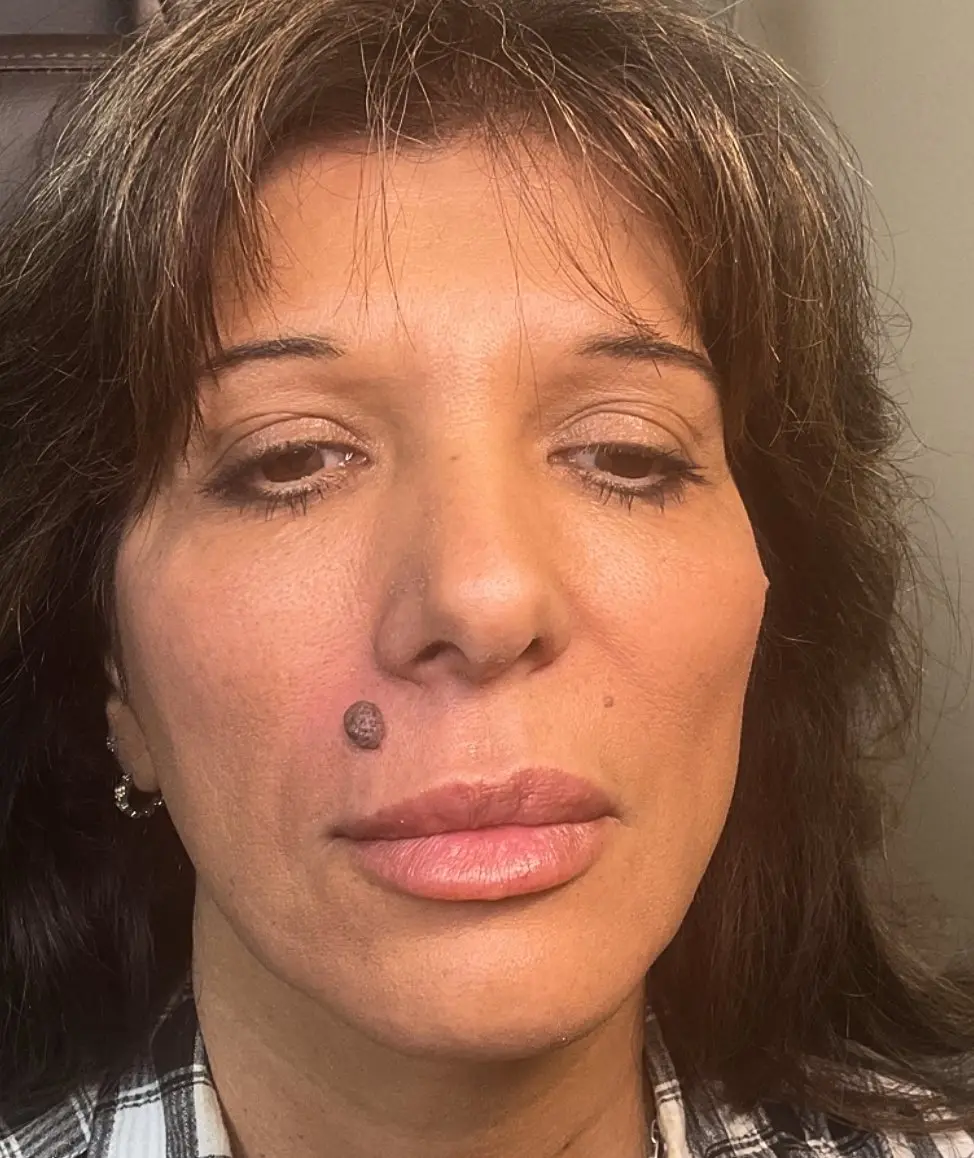 Facial mole before Plexr Plus removal
