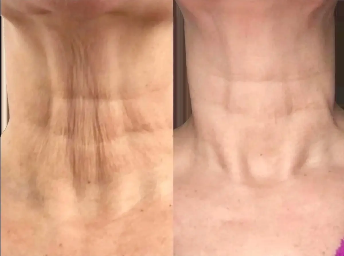 Neck lines before and after Plexr Plus plasma tightening