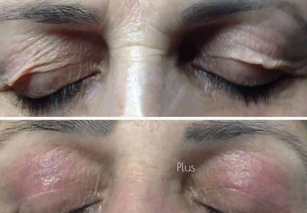 Upper eyelid before and after Plexr Plus plasma treatment